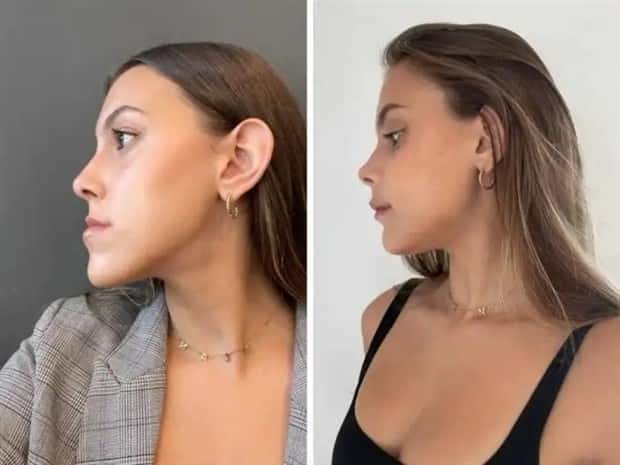 faces after plastic surgery (4)