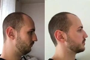 Amazing Face Transformations After Plastic Surgery (14 photos)